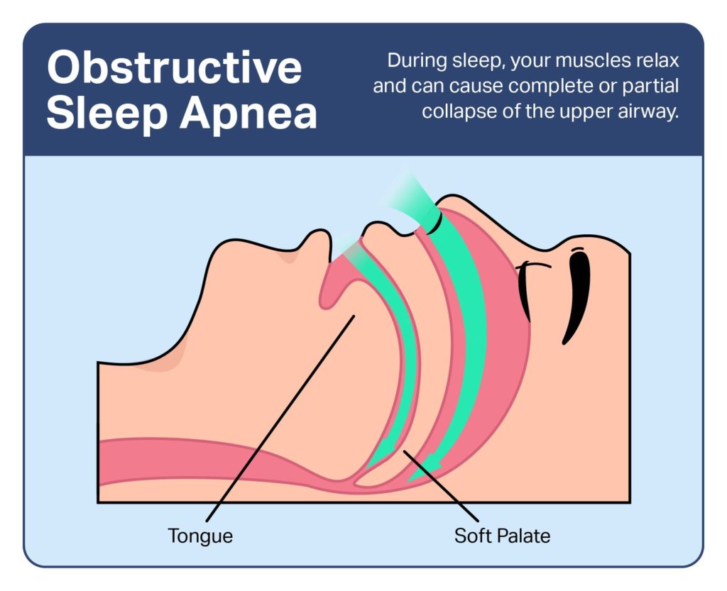 Infographic explaining obstruction to the airway caused by the tongue and soft palate.